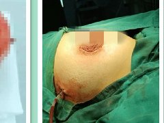 清丰第一医院乳腺科新年首例“乳腺巨大纤维瘤手术”圆满成功