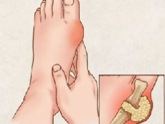 健康科普 | 关于痛风防治，你知道多少？