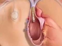 厉害！清丰第一医院介入科完成“输液港”—完全植入式静脉输液系统40余例