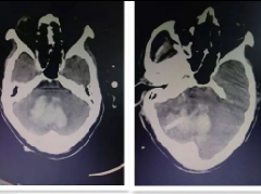 厉害！ 清丰第一医院神经外科成功开展“小脑出血钻孔引流术”填补县域空白