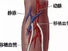 清丰第一医院介入科完成首例透析患者人工瘘成型手术