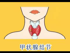射频消融术--甲状腺瘤患者的福音