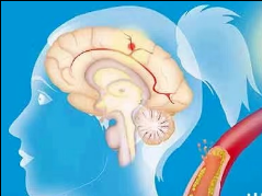 世界预防中风日：早发现 早预防 早治疗
